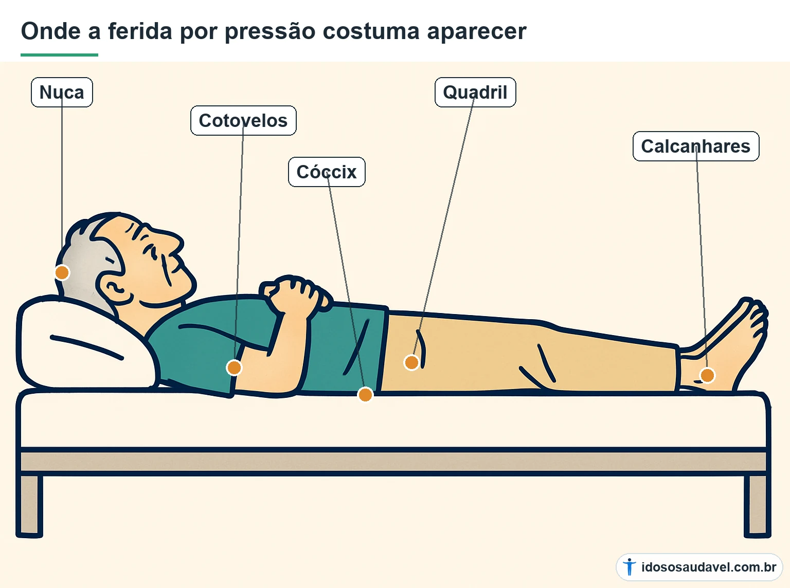 Pontos do corpo onde a ferida por pressão costuma aparecer no idoso acamado: nuca, cotovelos, cóccix, quadril e calcanhares